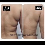 قبل و بعد لاغری سه