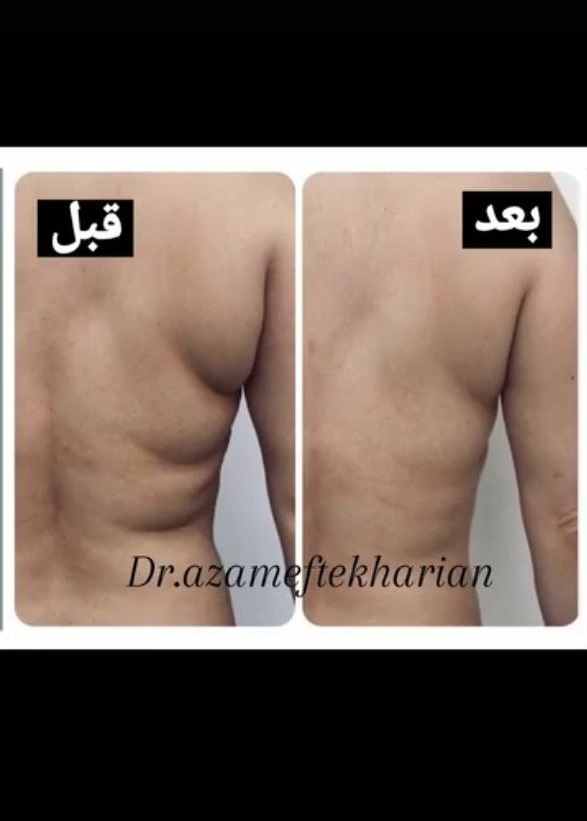 قبل و بعد لاغری سه